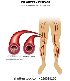 Healthy Leg Artery And Peripheral Arterial Disease, Atherosclerosis Progression, Narrowed Leg Artery And At The End Blood Clot May Block Artery