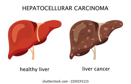 Healthy liver and liver cancer. Vector illustration.