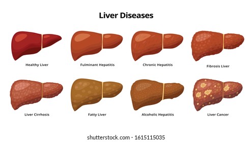 Healthy Liver And Liver Diseases - Fatty Liver, Hepatitis, Fibrosis, Cirrhosis, Alcoholic Hepatitis, Liver Cancer - Medical Infographic Elements Isolated On White Background.