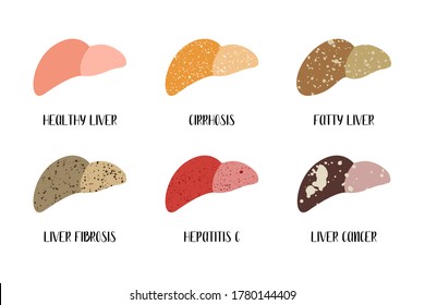 Healthy liver and various liver diseases. Hepatology. Stages of liver damage. Cirrhosis, fatty, fibrosis, hepatitis c, cancer. Vector flat illustration. Perfect for flyer, medical brochure, banner