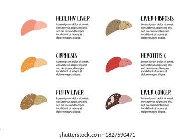 Healthy liver and various liver diseases. Hepatology. Stages of liver damage. Cirrhosis, fatty, fibrosis, hepatitis c, cancer. Vector flat illustration. Perfect for flyer, medical brochure, banner