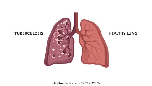 Tuberculosis Lungs Vs Healthy Lungs