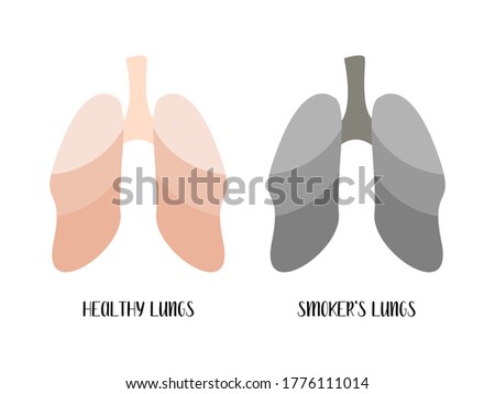 Healthy lungs and smoker's lungs. Pulmonology. Vector flat cartoon illustration. Perfect for banner, medical brochure, flyer