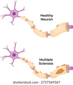 Healthy Neuron vs Multiple Sclerosis Demyelination Comparison