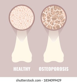 171 Osteoporotic Images, Stock Photos & Vectors | Shutterstock