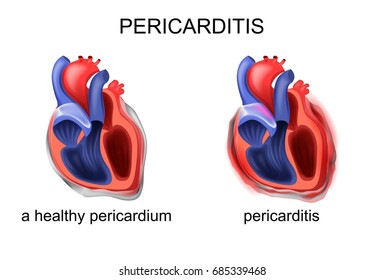 A Healthy Pericardium, Pericarditis