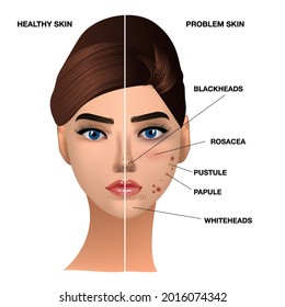 Cutis sana y problemática, acné y puntos negros, vector