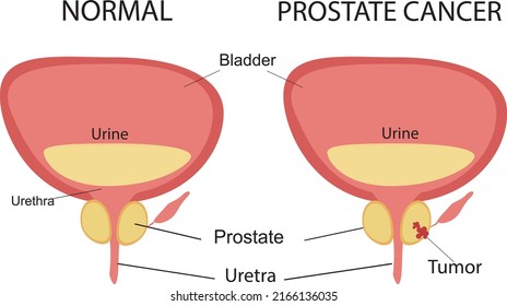 1,503 Prostate Drawing Images, Stock Photos & Vectors 