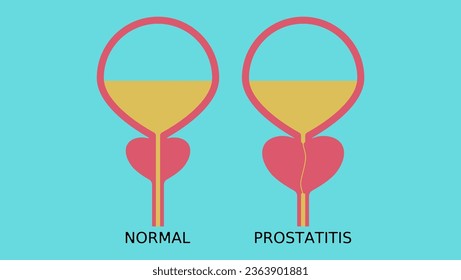 healthy prostate and prostatitis, high quality vector