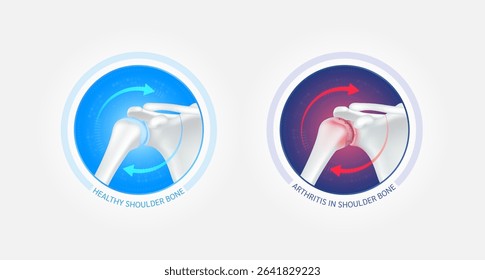 Healthy shoulder bone and arthritis or osteoporosis with red blue arrows spin around. Joint cartilage becomes worn. Comparative images of normal and inflammation bones. Vector EPS10.