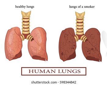 Healthy and sick lung table. Vector cartoon illustration. Smoker's lungs