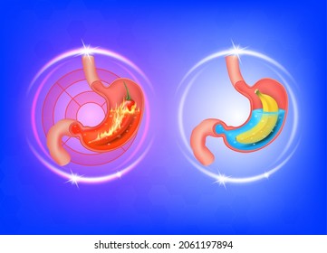 Healthy And Sick Stomach. Peppers And Bananas In The Abdomen. Stomach Heartburn. Gastritis And Acid Reflux. Healthy Food Nutrition Concept. 3D Vector.