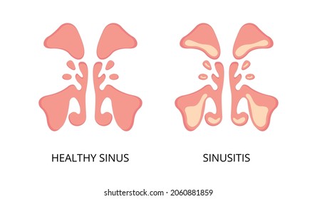 Healthy sinus and sinusitis flat image. Infection, inflammation, nasal diseases. Can be used for topics like health, diagnosis, anatomy