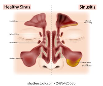 Healthy Sinus and Sinusitis or Rhinosinusitis. Excess Mucus and Sinus Infection