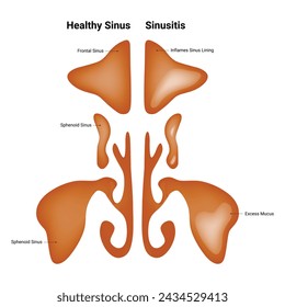 Healthy Sinus Sinusitis Science Design Vector Illustration Diagram