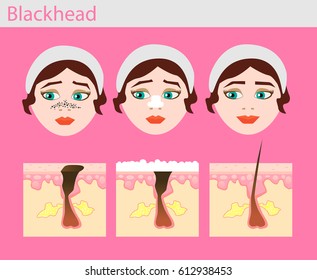 Healthy skin and Blackheads. Girl takes care of her face. Blackheads treatment procedure. Vector illustration.