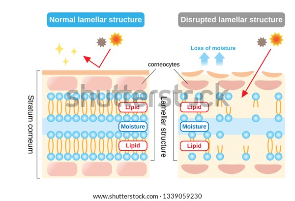 healthy skin\
and dry skin diagram.  structure of stratum corneum and lamellar\
structure, which play the protective role for skin barrier\
functions. beauty and skin care\
concept\
