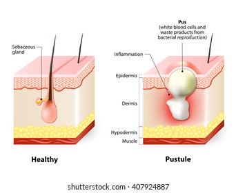 Healthy skin and Pustules