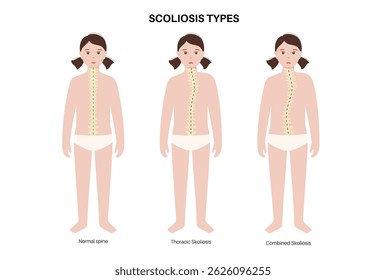 Healthy spine, combined and thoracic scoliosis in the girl body. Child spine anatomy, dorsal posture conditions. Spinal deformities in kids, curvature types flat vector illustration, vertebra diagram