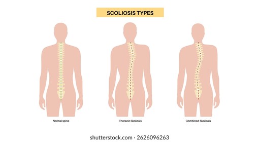 Coluna saudável, escoliose combinada e torácica no corpo masculino. Conceito de anatomia da coluna, condições da postura dorsal. Deformidades da coluna vertebral e tipos de curvatura ilustração vetorial, diagrama médico da vértebra