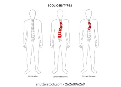 Coluna saudável, escoliose combinada e torácica no corpo masculino. Conceito de anatomia da coluna, condições da postura dorsal. Deformidades da coluna vertebral e tipos de curvatura ilustração vetorial, diagrama médico da vértebra