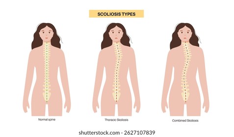 Healthy spine, combined and thoracic scoliosis in the woman body. Spine anatomy concept, dorsal posture conditions. Spinal deformities and curvature types vector illustration, vertebra medical diagram