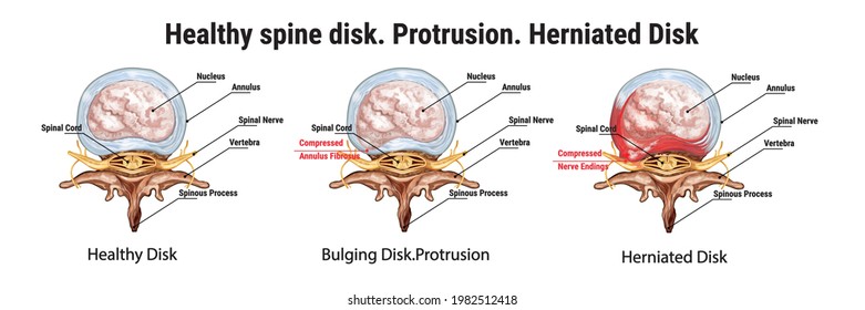 
Healthy spine disk. Protrusion. Herniated Disk. Bulging Disk. The anatomical structure of the spine. Compressed nerve endings. Medical vector illustration.