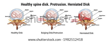 
Healthy spine disk. Protrusion. Herniated Disk. Bulging Disk. The anatomical structure of the spine. Compressed nerve endings. Medical vector illustration. Stock photo © 