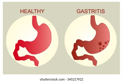 A healthy stomach and gastritis.