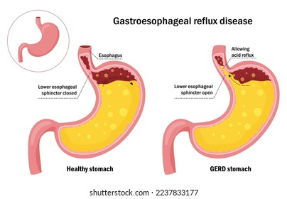 Healthy stomach and gastroesophageal reflux disease infographic. Gastric yellow juice in normal and GERD stomach. Cartoon design.
