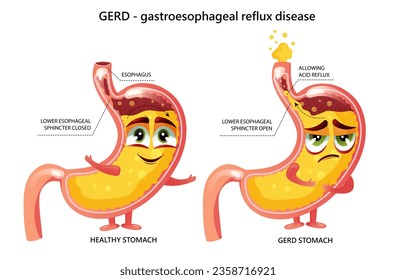 Healthy stomach and gastroesophageal reflux disease infographic. Gastric yellow juice in normal and GERD stomach. Cartoon design.
