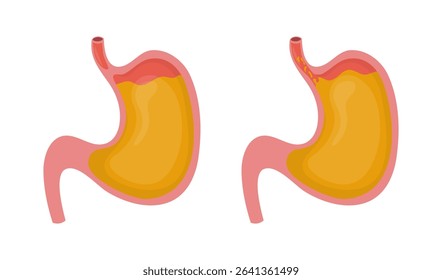 Healthy stomach and stomach with gastroesophageal reflux disease