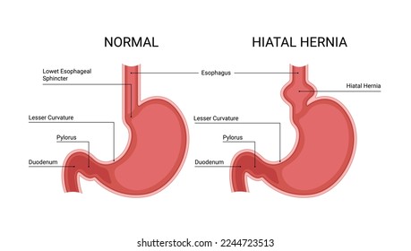 Healthy stomach and hiatal hernia infographic