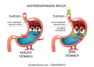 Healthy stomach and sad gastroesophageal reflux disease cartoon stomach characters. Gastric juice in normal and GERD stomach. Vector illustration on white background
