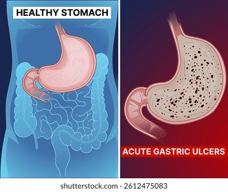 Healthy stomach. Unhealthy stomach. Acute gastric ulcers, gastritis. Gastroesophageal reflux disease. Peptic ulcer disease. Digestive system. Humans' anatomical structure. Medical illustration, vector