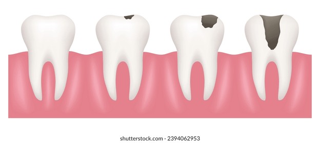 Dientes y dientes sanos con caries. Vector clipart.