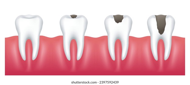 Healthy teeth and teeth with caries. Vector clipart.