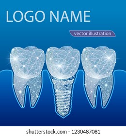 Healthy teeth and dental implant. Dentistry. Implantation of human teeth. Vector illustration