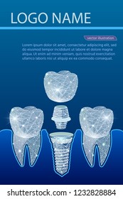 Healthy teeth and dental implant. Dentistry. Implantation of human teeth. Vector illustration