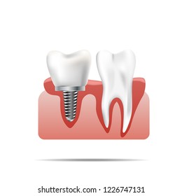 Healthy teeth and dental implant. Realistic illustration of tooth medical dentistry. Human teeth dental implantation.