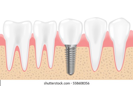 Healthy teeth and dental implant. Realistic vector illustration of tooth medical dentistry. Human teeth dental implantation