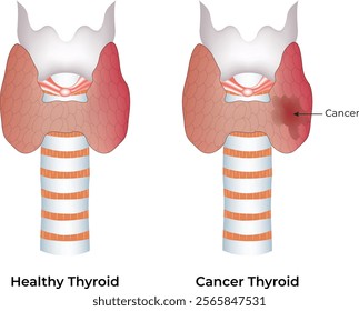 Healthy Thyroid Cancer Thyroid Design Vector Illustration