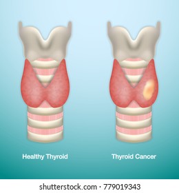 Healthy Thyroid and Thyroid Cancer. Vector Illustration.