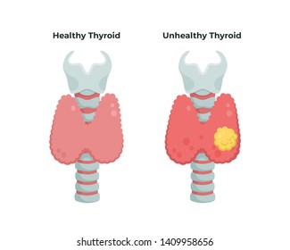 Healthy Thyroid gland and unhealthy thyroid with Inflammation and lump, thyroid cancer concept, flat illustration isolated on white background. Medical  infographic elements.