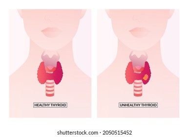 Healthy Thyroid Gland And Unhealthy Thyroid With Inflammation And Lump, Thyroid Cancer Concept.