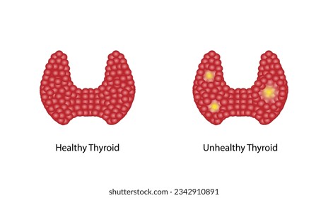 Healthy Thyroid gland and unhealthy thyroid with Inflammation and lump, thyroid cancer. Vector illustration isolated on white background.