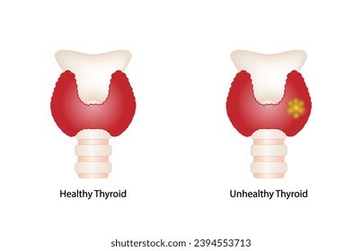 Healthy Thyroid gland and unhealthy thyroid with Inflammation and lump, thyroid cancer. Vector illustration isolated on white background.