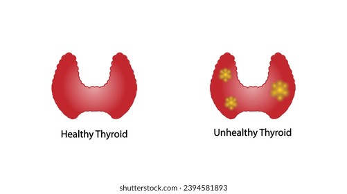 Healthy Thyroid gland and unhealthy thyroid with Inflammation and lump, thyroid cancer. Vector illustration isolated on white background.