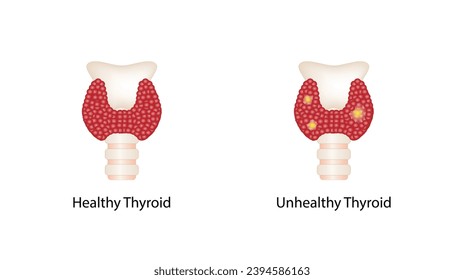 Healthy Thyroid gland and unhealthy thyroid with Inflammation and lump, thyroid cancer. Vector illustration isolated on white background.