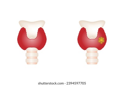 Healthy Thyroid gland and unhealthy thyroid with Inflammation and lump, thyroid cancer. Vector illustration isolated on white background.